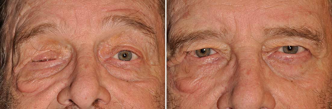 Patient of ocular prosthetics before and after photos.